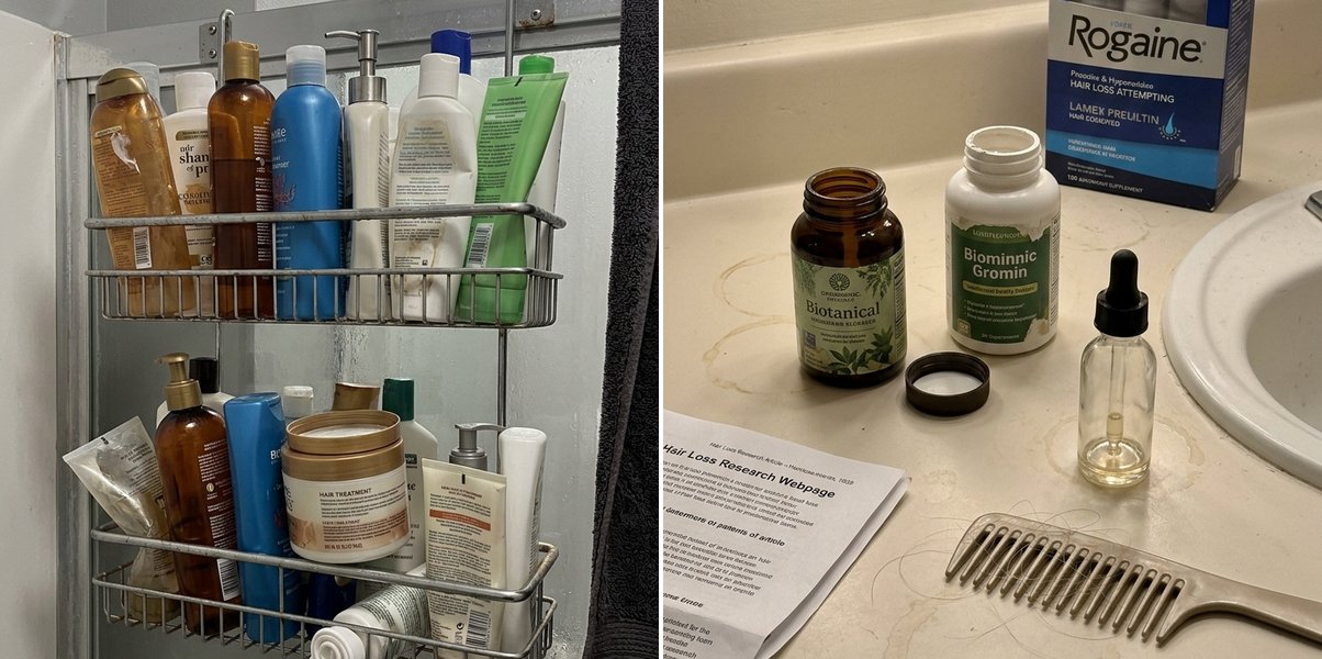 Failed shampoos and Rogaine treatments